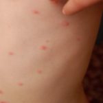 Focar de varicelă la o școală din Gorj: Zeci de elevi s-au îmbolnăvit