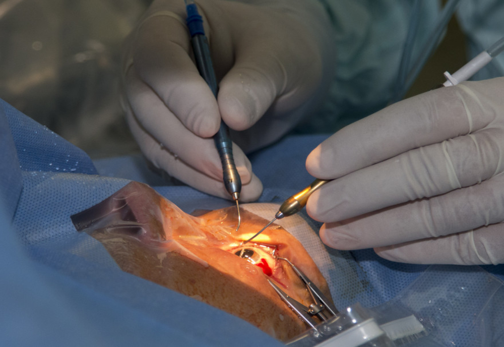 Transplant de cornee la Spitalul „Sf. Spiridon” Iași