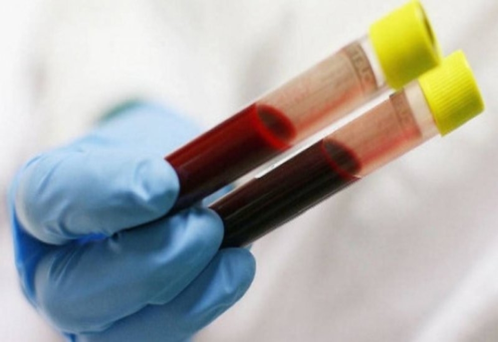 Un nou test de sânge ar putea revoluționa diagnosticul de cancer