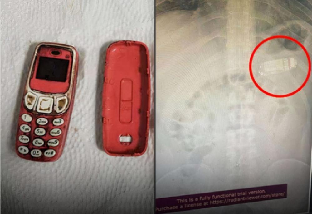 Incredibil! Un a scos un telefon marca Nokia 3310 din stomacul unui deţinut