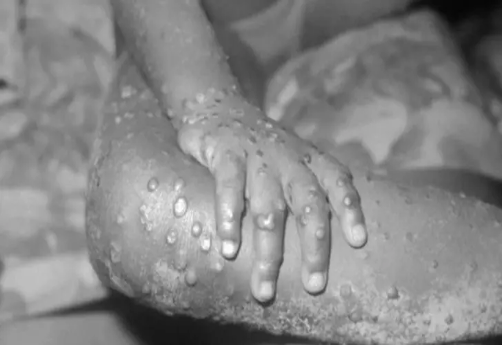 Al şaselea caz de variola maimuţei, depistat în România