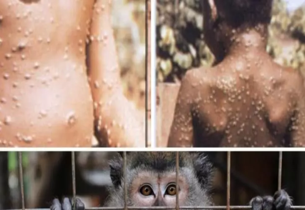 Alertă la OMS: Reuniune urgentă după cele peste 6.000 de cazuri de variola maimuței în 58 de ţări