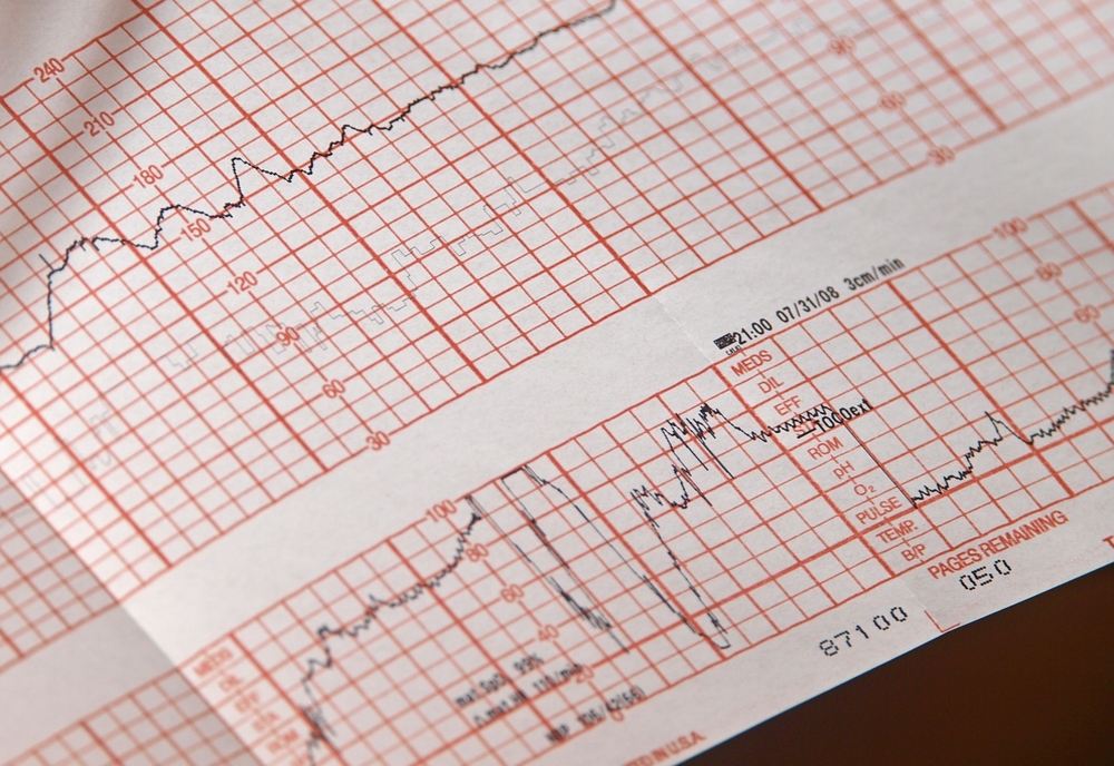 Ce este electrocardiograma (EKG)?