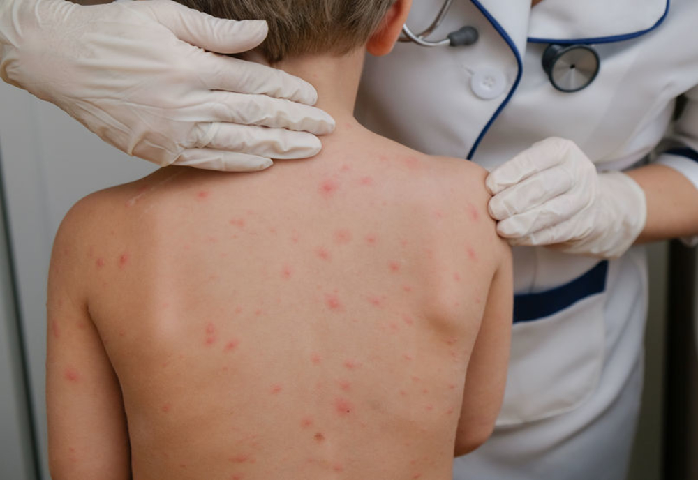 Creștere alarmantă a cazurilor de varicelă într-un județ din țară