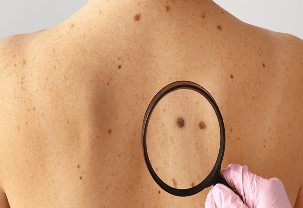 Regula cu ajutorul căreia poți identifica din timp cancerul de piele